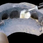 When to use a clear silicone: clinical applications