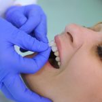 Dental veneers: materials and preparation techniques