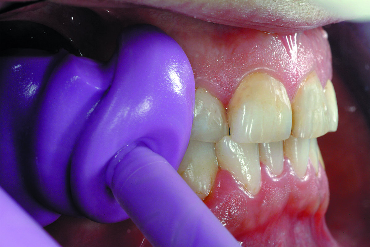 Cire pour l’enregistrement de morsure / Rebords occlusaux droits