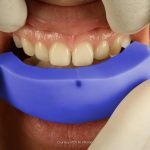 mock-up-dentale-diretto