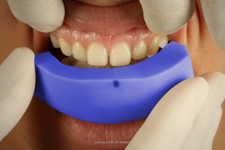 Realizzare un mock-up dentale diretto alla poltrona