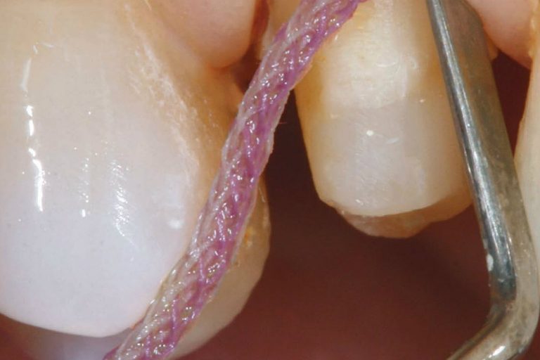 Liquidi astringenti per inibire i fili retrattori