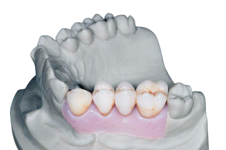 Duplicazione di un profilo di emergenza con silicone Gingifast Elastic