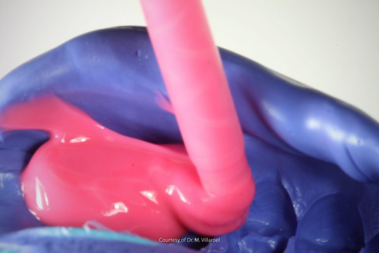 Vantaggi e svantaggi delle diverse tecniche di impronta dentale