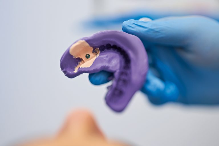Impronta su impianti paralleli e angolati: criticità e utilizzo dei materiali
