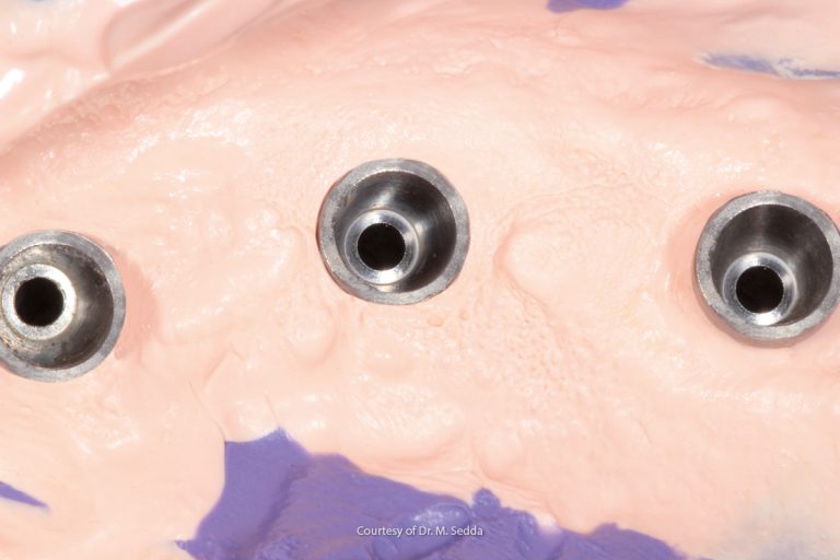 L’utilizzo del light nell’impronta di protesi implantare