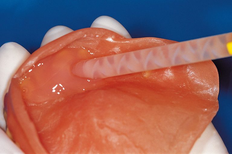 Hard e Soft Relining: quando usare l’una e quando l’altra