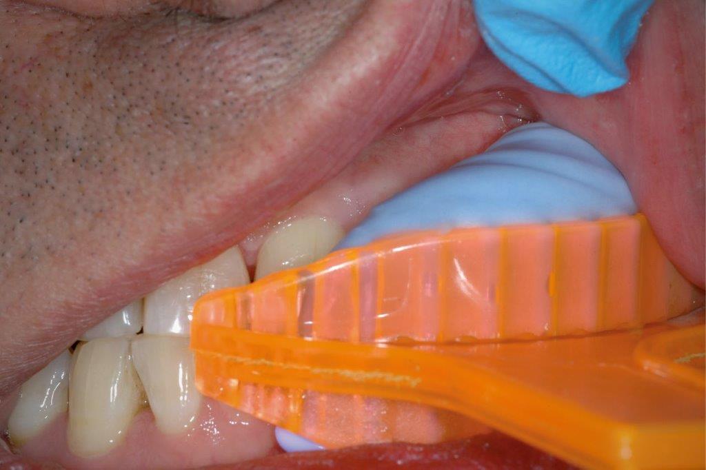 The dual arch impression taking