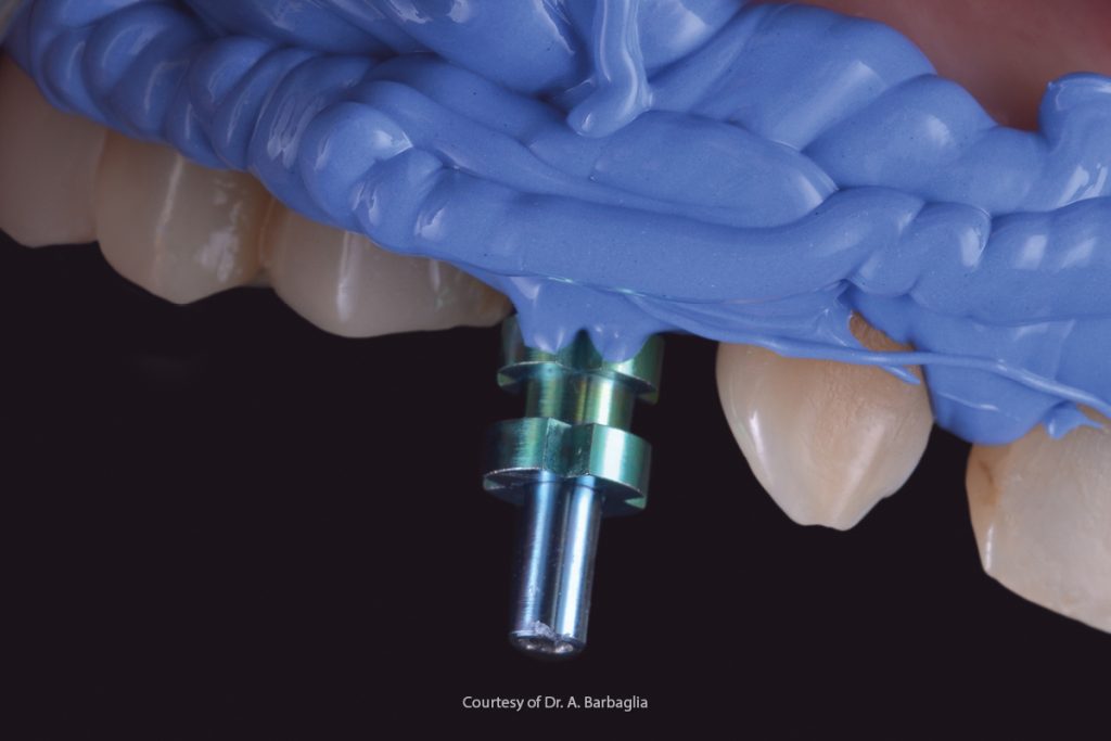 L'impronta in implantologia