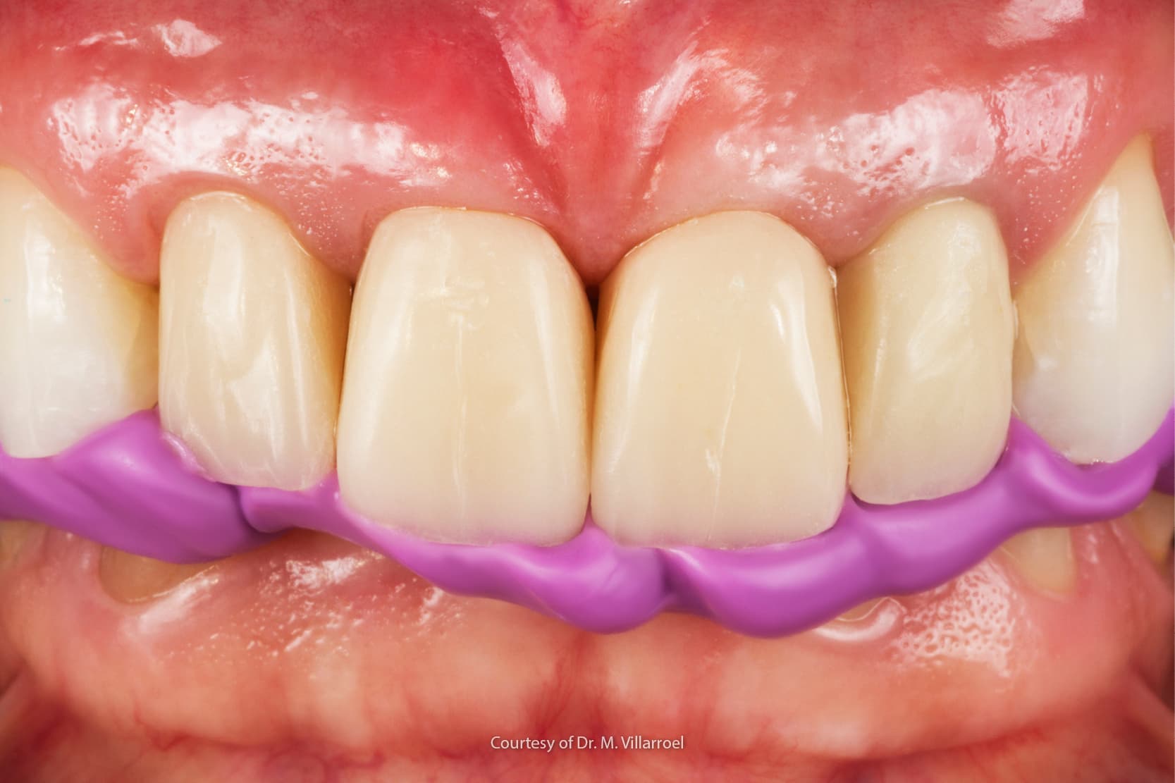 Bruxismo dental: causas, síntomas y tratamiento