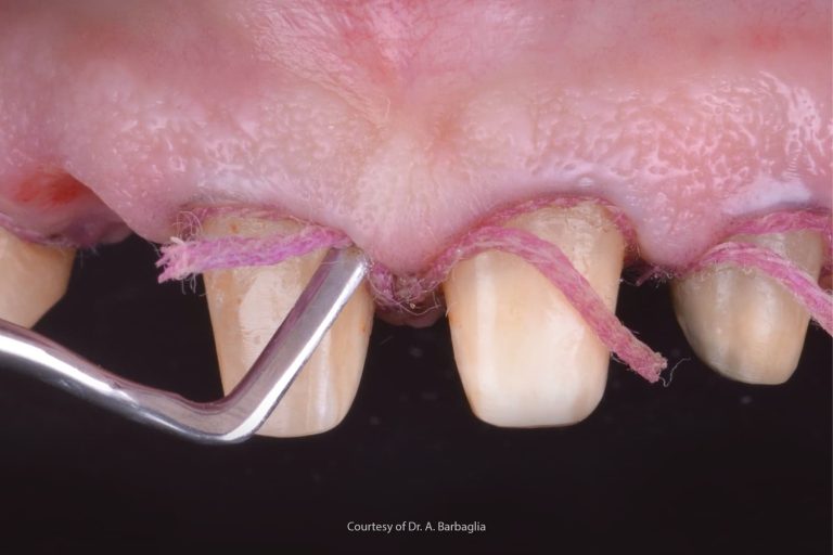 Astringenti, emostatici e vasocostrittori nella presa d’impronta