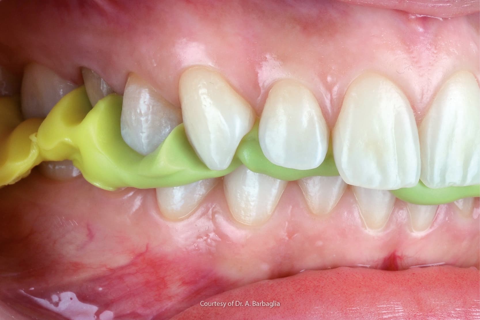 Importance et indications de l'enregistrement occlusal