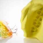 A comparison between clear aligners and traditional braces