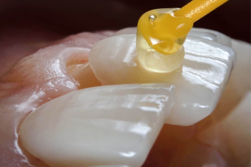 Dental-veneer-cementing