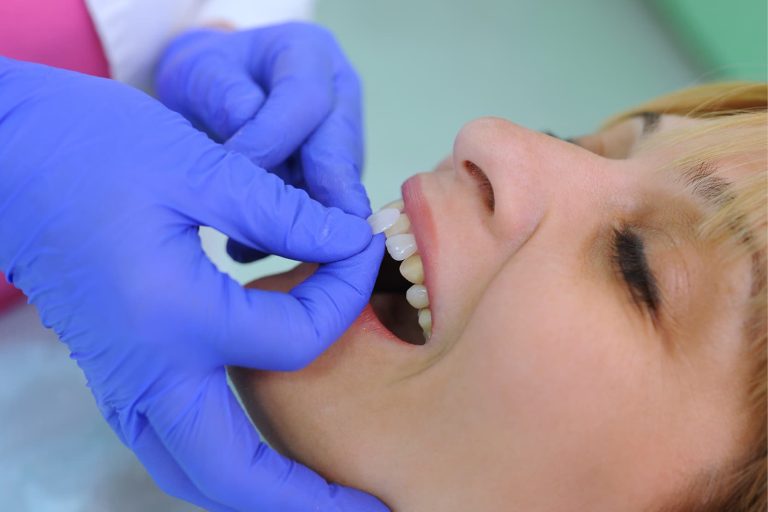 Carillas dentales: materiales y técnicas de preparación