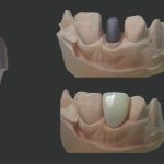 Custom-made endodontic posts, impressions and fabrication techniques