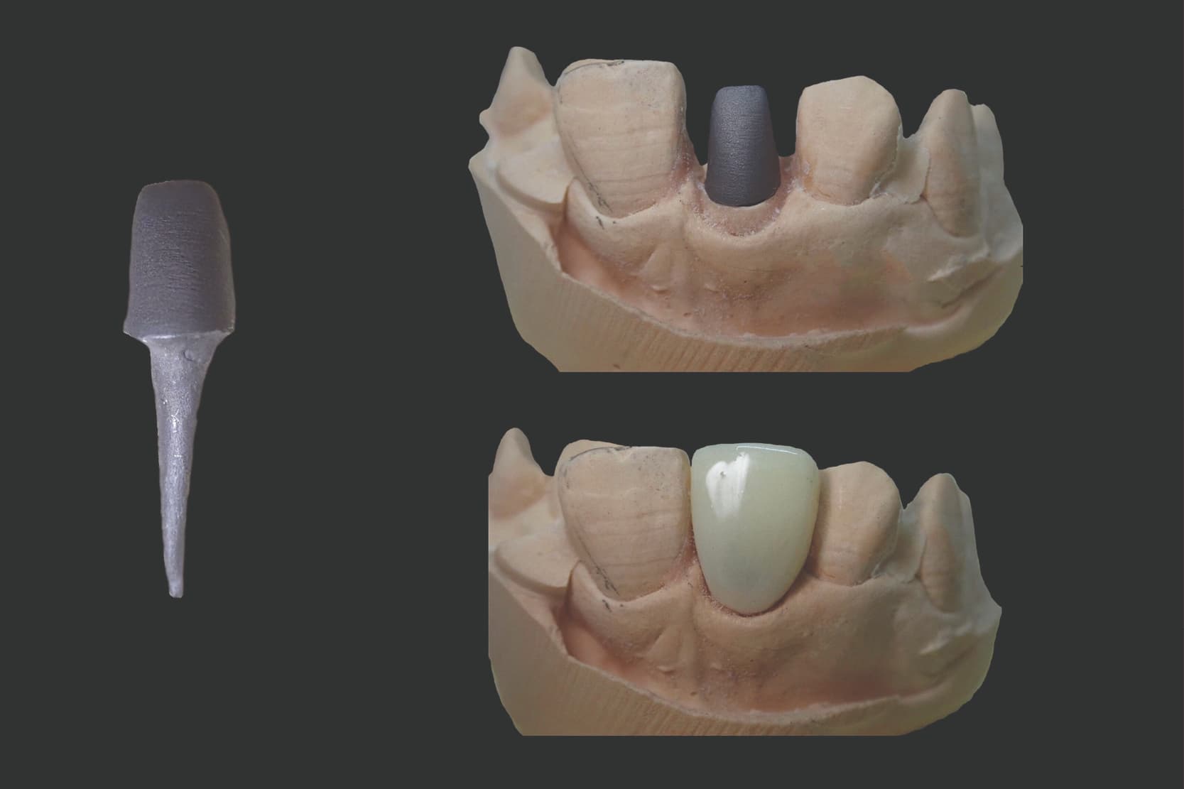 Custom-made endodontic posts: fabrication techniques