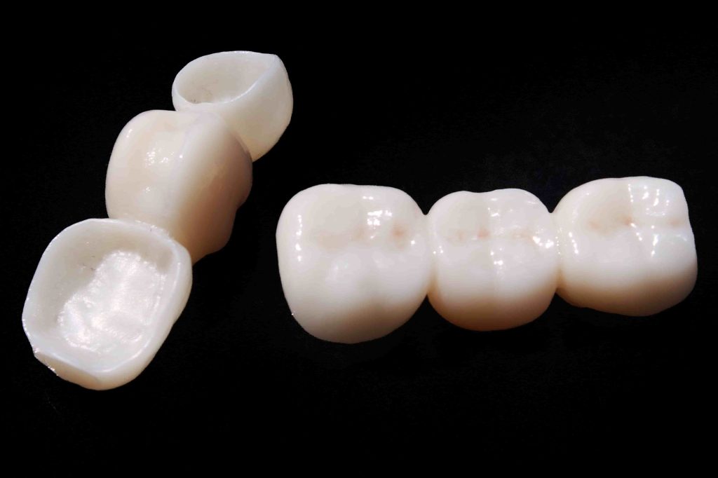 L’impronta nella B.O.P.T. (Biologically Oriented Preparation Technique): principi di preparazione dentale.