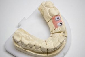 Protesi fissa su impianti multipli: procedure tecniche per la realizzazione.