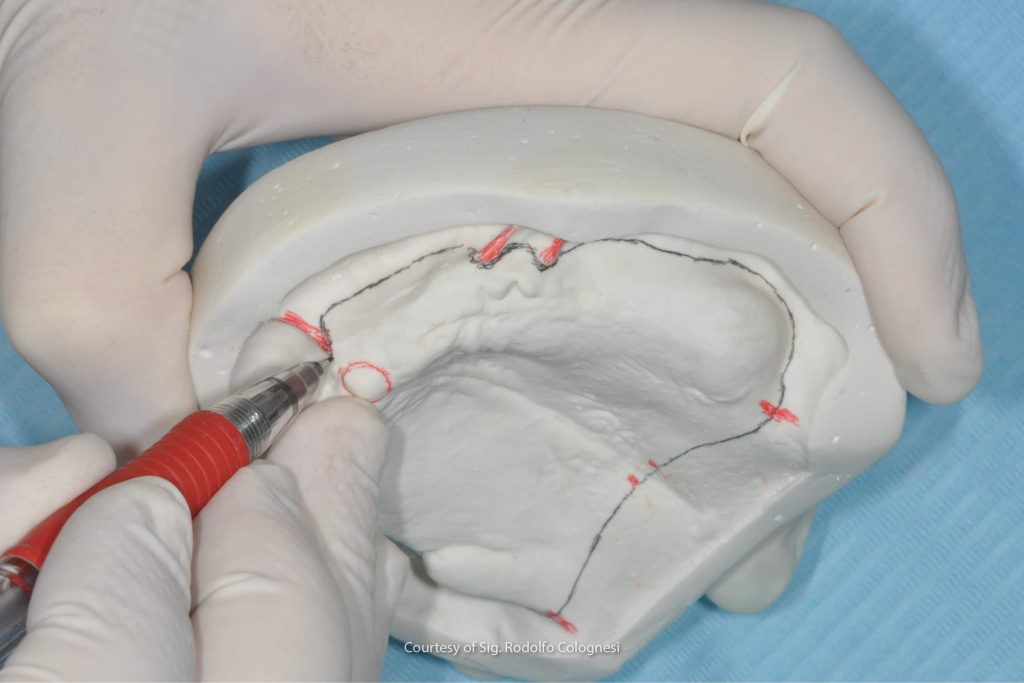 Procedure tecniche per la realizzazione di protesi mobile: fasi di progettazione e realizzazione della protesi mobile totale, un processo tra clinico e odontotecnico che richiede esperienza e cura del dettaglio.