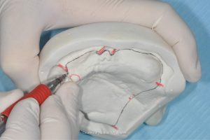 Procedure tecniche per la realizzazione di protesi mobile: fasi di progettazione e realizzazione della protesi mobile totale, un processo tra clinico e odontotecnico che richiede esperienza e cura del dettaglio.