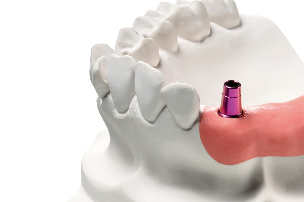 Realizzazione di protesi fissa su impianto singolo: le procedure tecniche