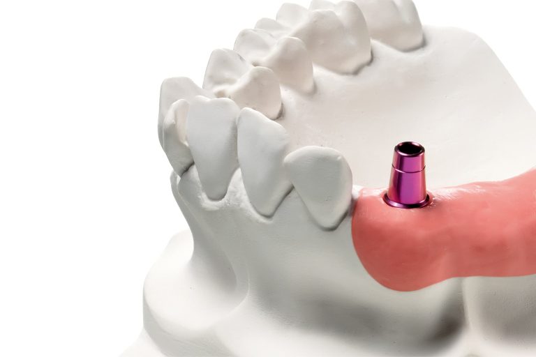 Realizzazione di protesi fissa su impianto singolo: le procedure tecniche