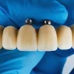 I materiali da rivestimento per i framework protesici dentali.