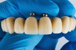I materiali da rivestimento per i framework protesici dentali.
