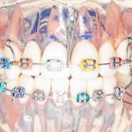 Miniviti e ancoraggio assoluto in ortodonzia: vantaggi, materiali e applicazioni.