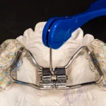 Ortodonzia intercettiva: quando intercettare una malocclusione con trattamento precoce.