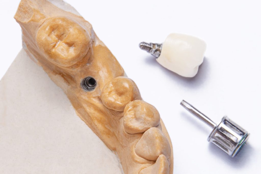 Fattori di precisione occlusale delle corone su impianti con workflow analogico e digitale.