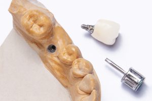 Fattori di precisione occlusale delle corone su impianti con workflow analogico e digitale.