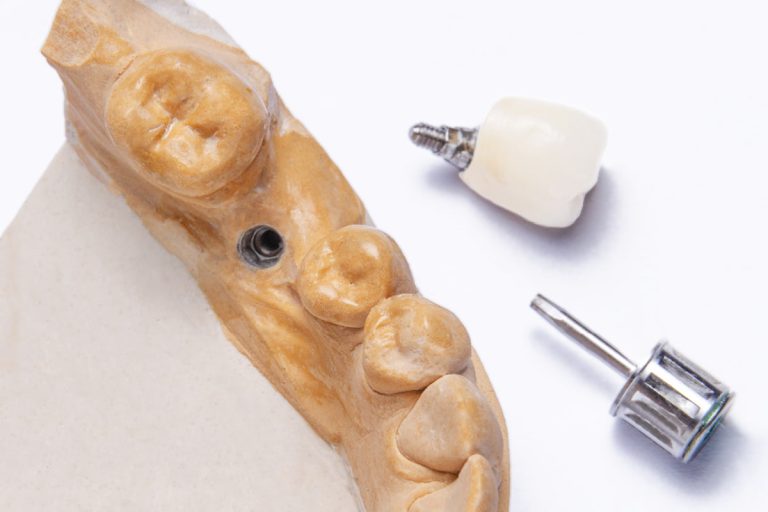 Fattori di precisione occlusale delle corone su impianti con workflow analogico e digitale