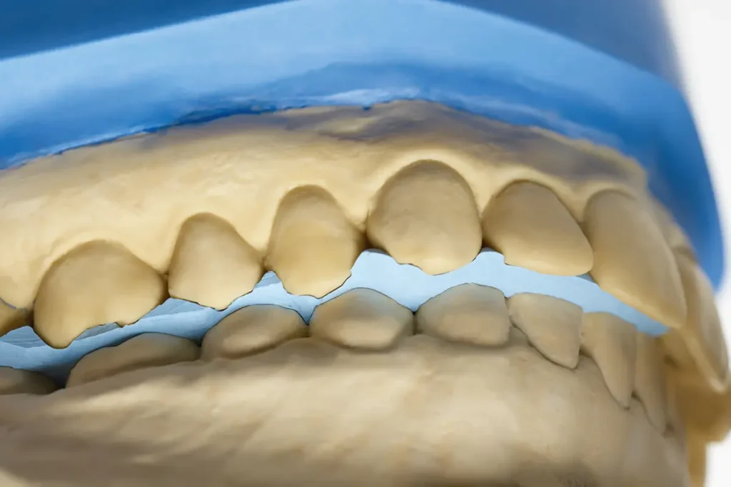 I materiali scansionabili da occlusione nella pratica clinica.