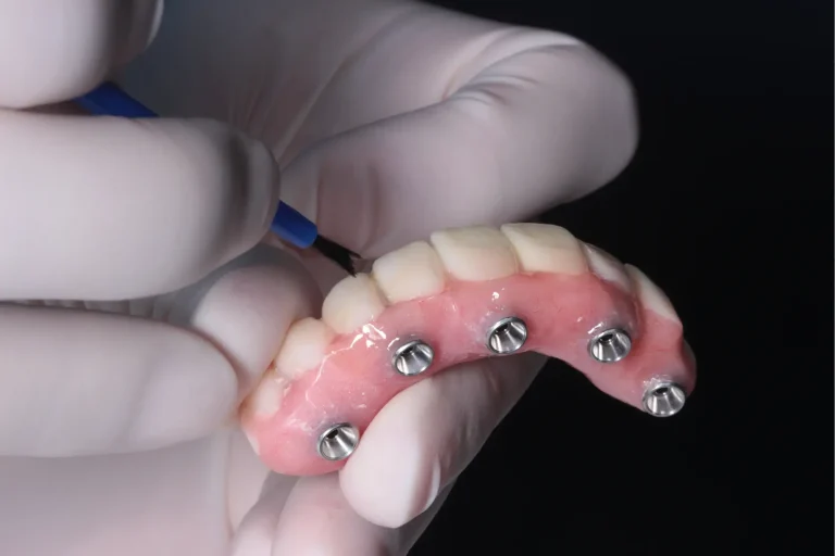 Il misfit implanto-protesico: impronta analogica e digitale e altri fattori coinvolti