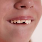 Traumi dentali: classificazione e linee guida di primo intervento.