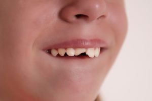 Traumi dentali: classificazione e linee guida di primo intervento Traumi dentali: classificazione e linee guida di primo intervento.