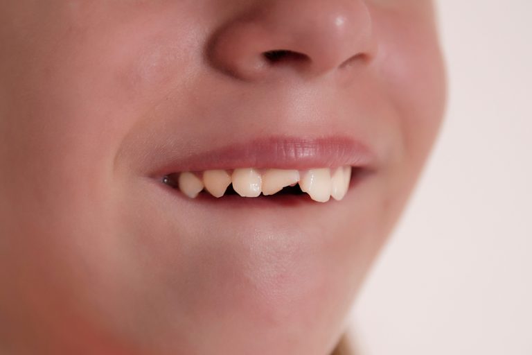 Traumi dentali: classificazione e linee guida di primo intervento