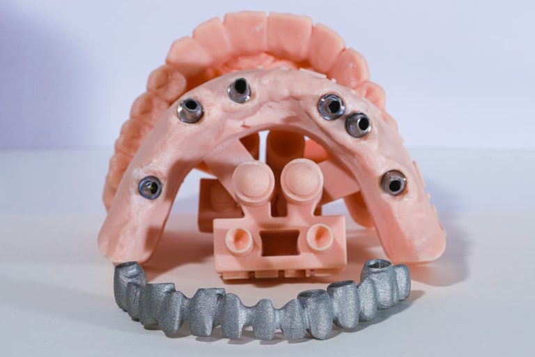 Tecnologie analogiche e digitali nella realizzazione dei framework implantari