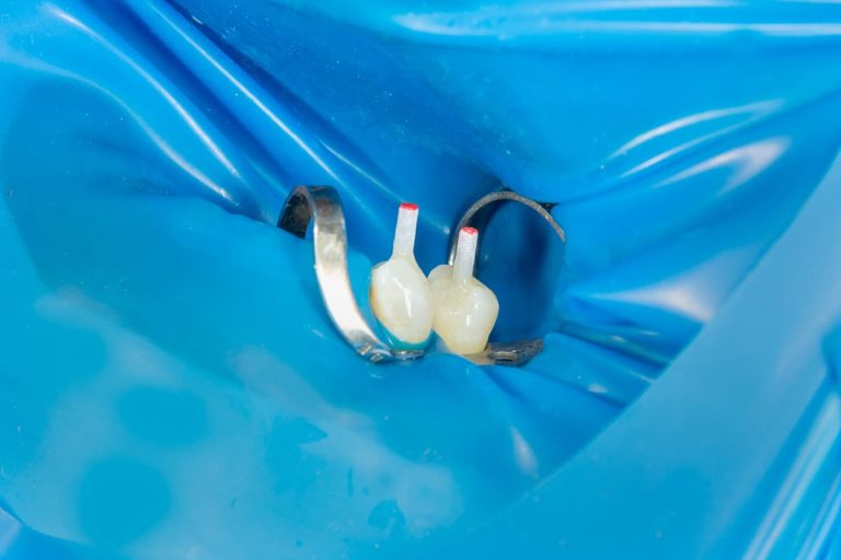 Restauro post endodontico: evidenze in letteratura e prospettive cliniche
