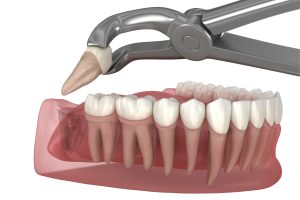 Dental autotransplants: evidence in the literature and clinical perspectives Autotrapianti dentali: tecnica, fattori di successo e complicanze.