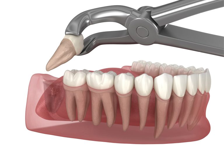 Autotrapianti dentali: evidenze in letteratura e prospettive cliniche