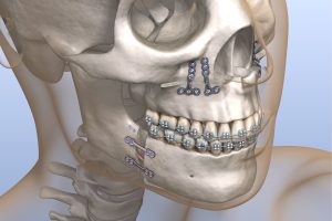 Ortodonzia pre-chirurgica e chirurgia ortognatica: razionale, indicazioni e protocolli .