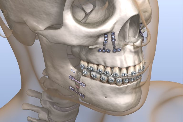 Ortodonzia pre-chirurgica e chirurgia ortognatica: razionale, indicazioni e protocolli