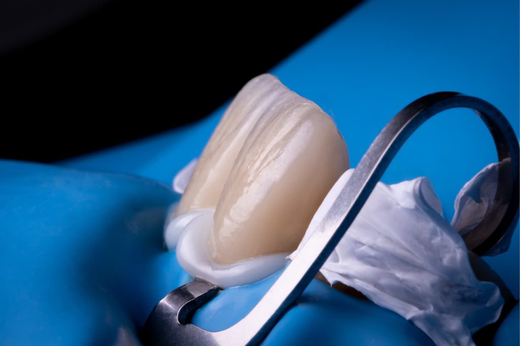 Cemento dentale per protesi