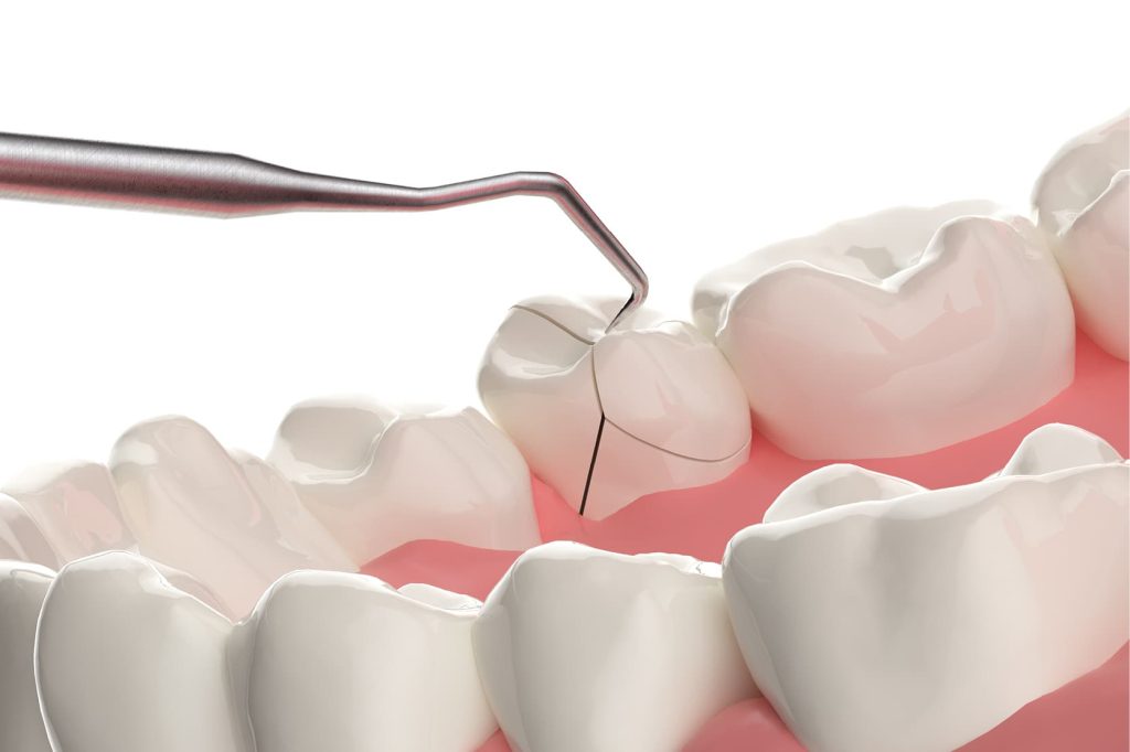 Cracked tooth syndrome; causes, symptoms and how to fix.