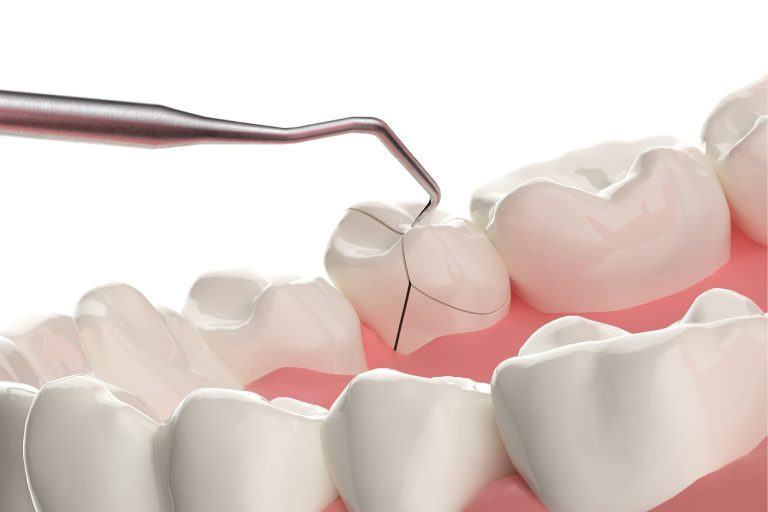 La sindrome del dente incrinato: cause, sintomi e trattamenti