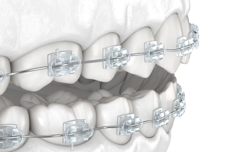 Estrusione ortodontica: tecniche e vantaggi per il trattamento dentale