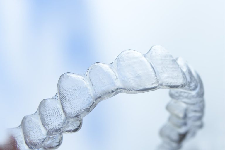 I limiti dell’ortodonzia con allineatori dentali
